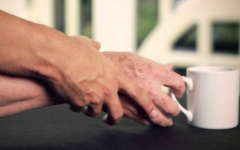 “Quienes no se tratan el Mal de Parkinson pueden terminar con demencia o Alzheimer”