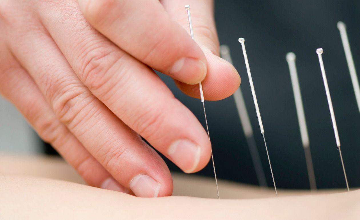 Acupuntura: ¿Cómo funciona y por qué es beneficiosa para la salud?