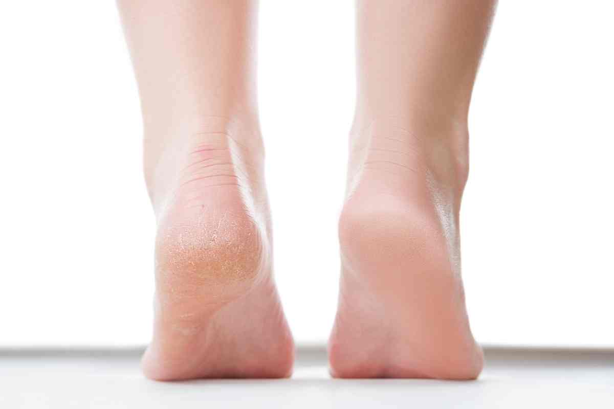 Teñido de pies y muslos: un enemigo temido del verano